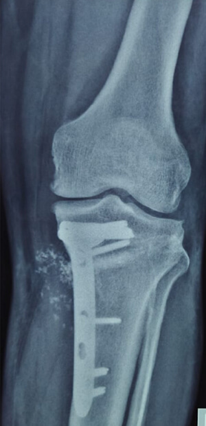 DEFORMITY CORRECTION