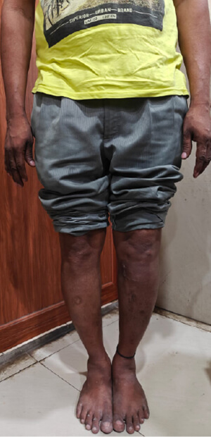 DEFORMITY CORRECTION